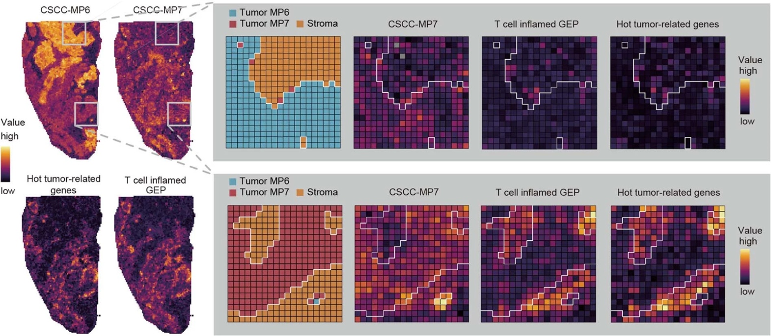 Figure 3. Spatial structures of MP6 and MP7 regions. MP7 shows spatial co-localization of malignant regions with immune inflammatory genes, while the absence of immune signaling in MP6 reveals its immune exclusion characteristics. 